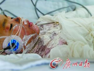 女孩遭父親用開水淋燙 燒傷面積達85%